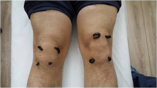 Sülük Uygulaması (Hirudoterapi)