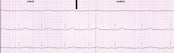 Electrocardiogram_of_a_healthy_man,_21_years_old.webp