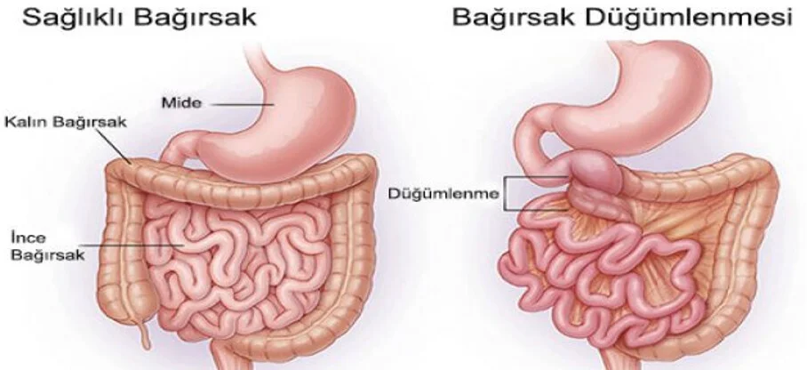 Bağırsak Düğümlenmesi (Volvulus)